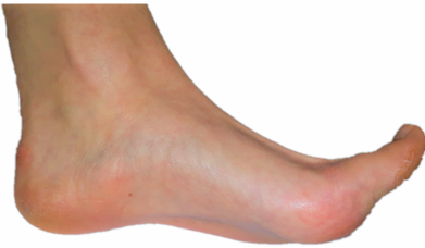 Plantar Fasciitis - What, Why, and How