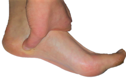 Plantar fascia insertion point