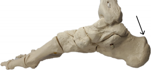 Achilles tendon bone spur location