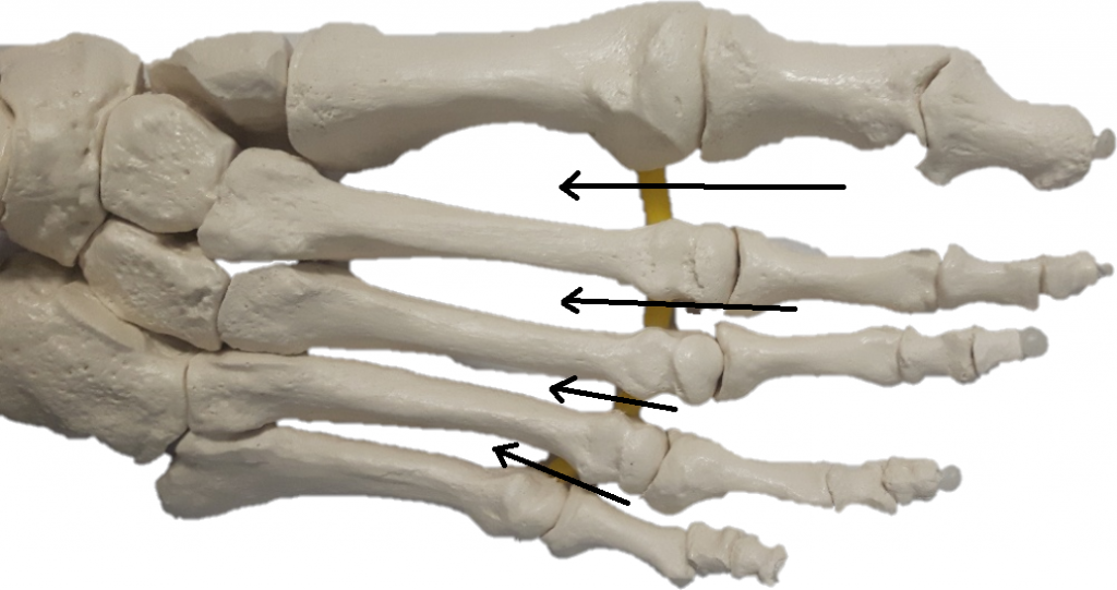 Morton's Neuroma The What, Why and How On the Ball Orthotics Morton's Neuroma The What, Why and How On the Ball Orthotics