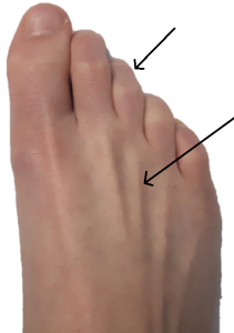 Metatarsal arch collapse with clawed toes and tight tendons, which can lead to Morton's neuroma