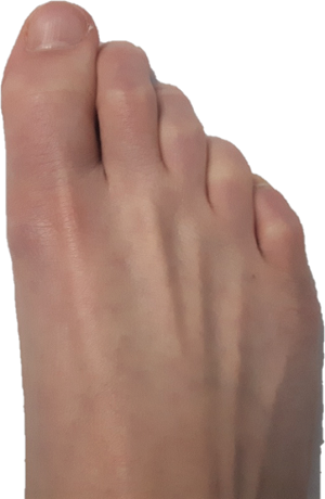 Metatarsal arch collapse, which can lead to Morton's Neuroma