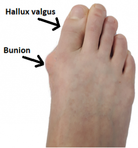 View of the top of the foot with a bunion and hallux valgus