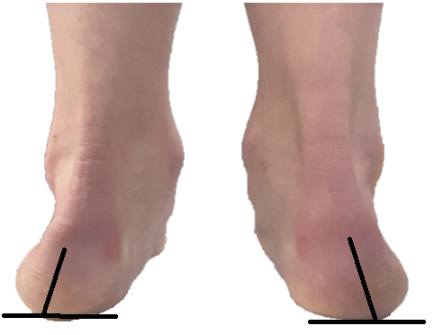 View of two feet from the back of the heels. Heels turning in towards each other, which is typical for posterior tibial tendon dysfunction (PTTD). 