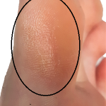 Callus on the inside of the big toe