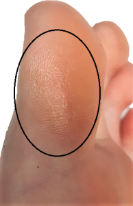 Callus on the inside of the big toe