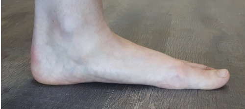 Left foot with a moderately low arch. This can lead to pain when starting a new exercise routine.