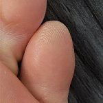 Callus on the pinky (5th) toe