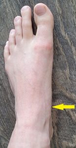 Navicular stress fracture location