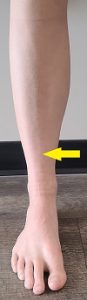Tibial stress fracture location