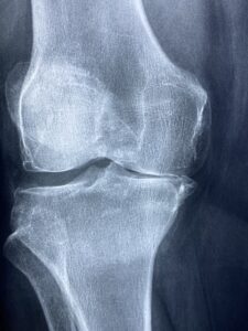 Xray of the medial knee joint narrowing