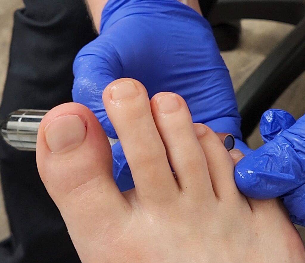 Footcare with an ingrown nail removed