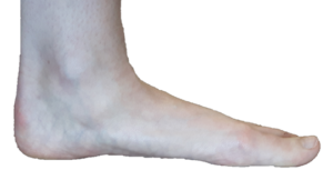 Flat foot, view of the inside of the foot