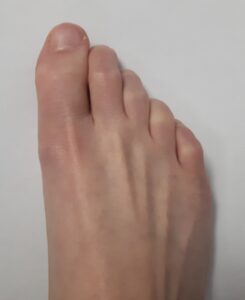 View of the top of the foot with a metatarsal arch collapse and clawed toes